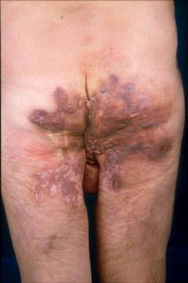 Hidradenitis suppurativa 