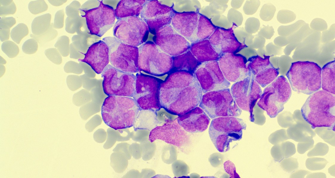 Foto von Leukämie-Zellen