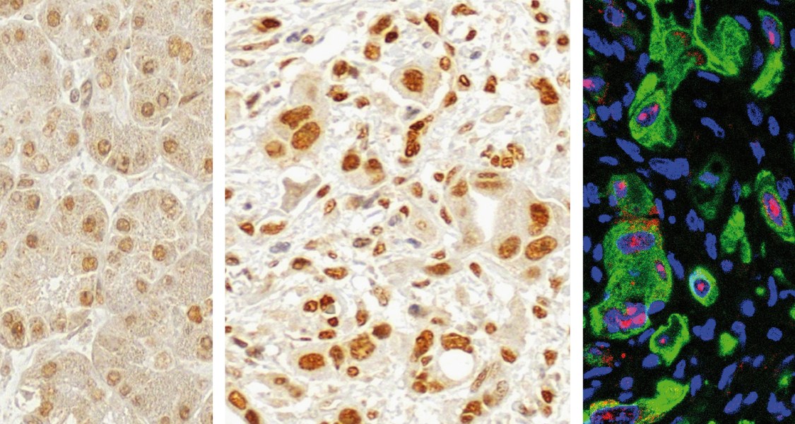 Die Mehrzahl der Bauchspeicheldrüsentumore weist einen höheren Gehalt des Enzyms PRMT1 auf (mittleres Bild) als krebsfreies Gewebe des Organs (Bild links), wie die Intensität der Braunfärbung zeigt. Zusammen mit dem Krebshemmer p14ARF (rot gefärbt) im Tumorgewebe wirkt sich PRMT1 günstig auf den Therapieerfolg und die Langzeitprognose aus.