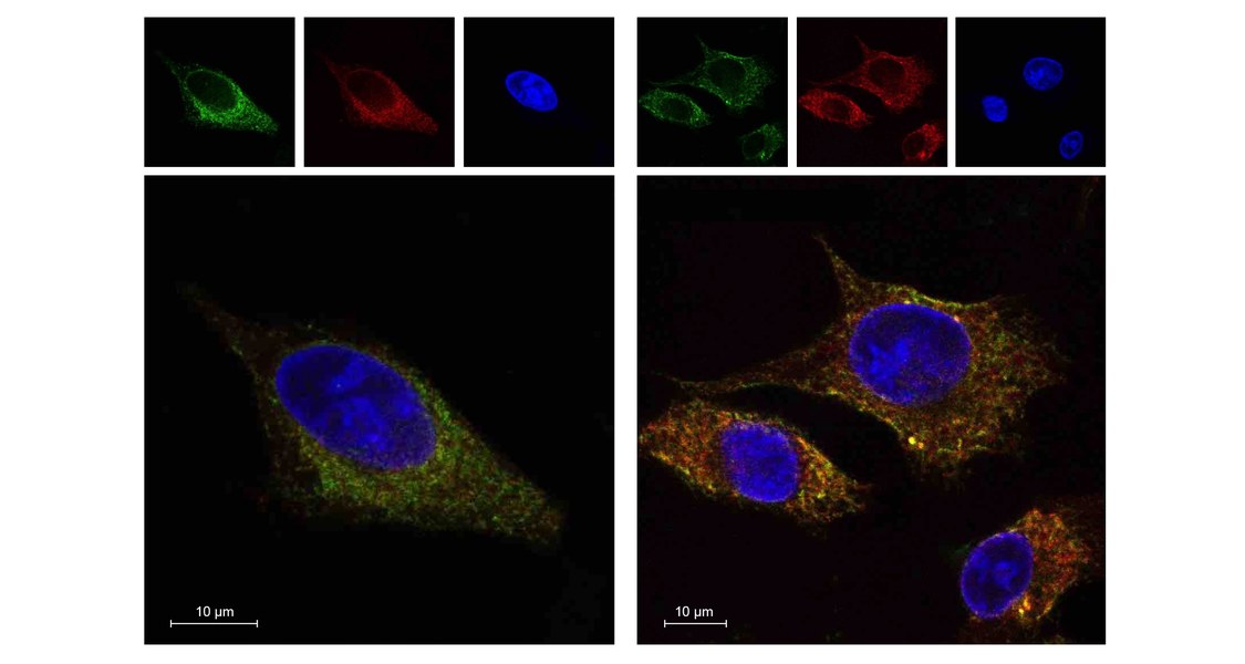 Gefährliche Zusammenrottung: Liegt in einer Tumorzelle mutiertes p53 vor, so reichert sich das Protein ENTPD5 (grün gefärbt) in Membranen (rot) innerhalb der Zellen an. Zusammen wirken sie so auf Integrine ein, dass sich die Beweglichkeit der Tumorzelle erhöht. Foto: Michael Wanzel