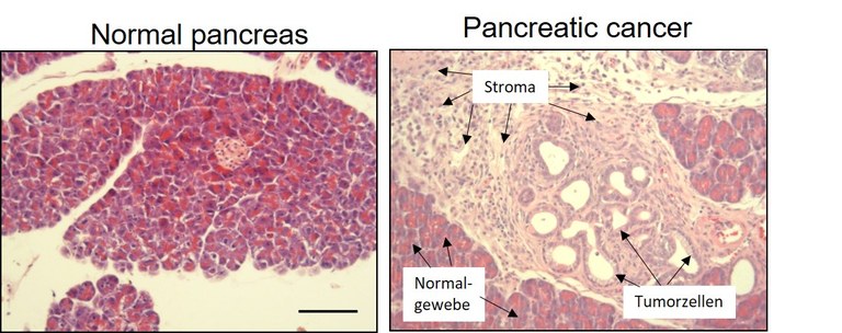 Figure 1: Tissue section of a normal pancreas (left) and of pancreatic cancer (right). Note the prominent stroma reaction in the cancer tissue.